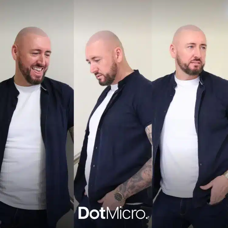 Full scalp micropigmentation creating a consistent shaved scalp appearance