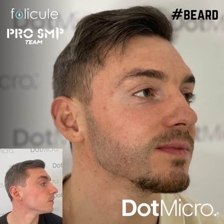 Beard micropigmentation results improving density and definition in patchy areas
