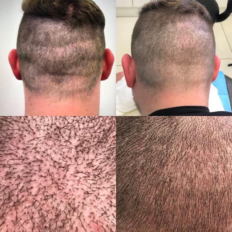 Scalp micropigmentation scar camouflage blending pigment with surrounding hair
