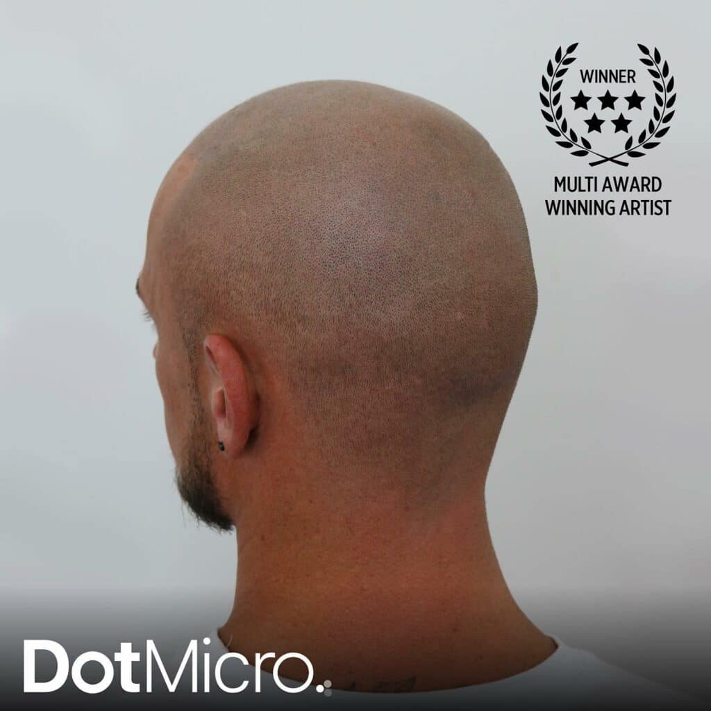 Rear view of shaved scalp micropigmentation showing even pigment coverage