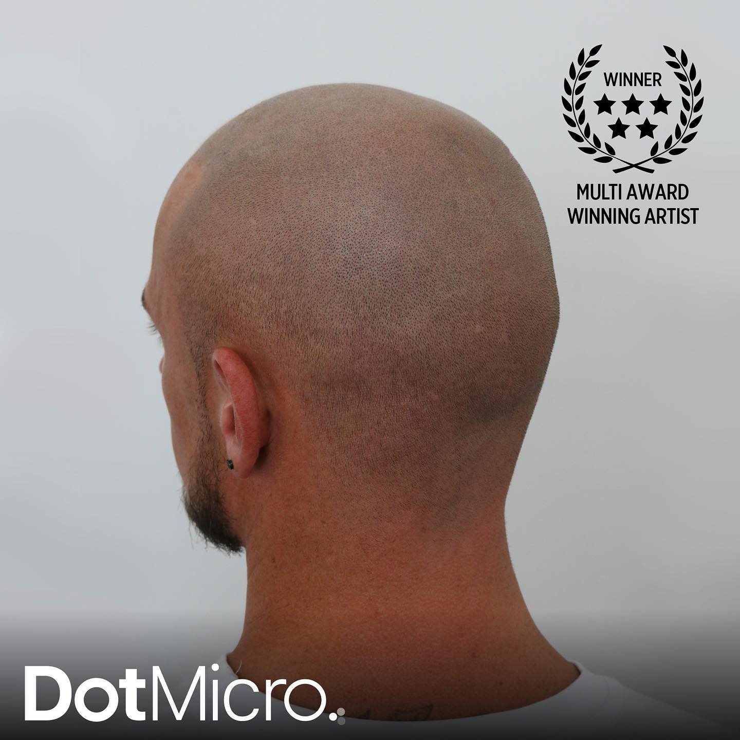 Rear view of shaved scalp micropigmentation showing even pigment coverage