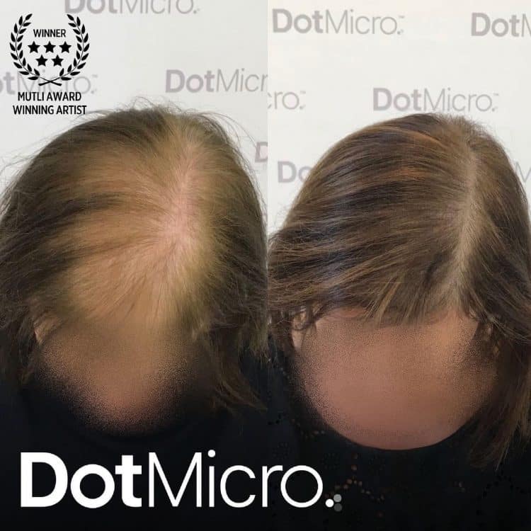 Female scalp micropigmentation for thinning hair with improved visual density