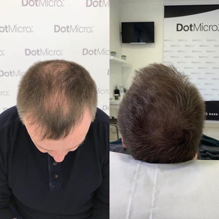 Male scalp micropigmentation for thinning hair showing increased density effect