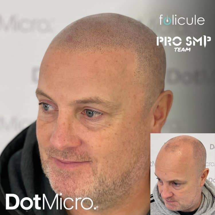 Scalp micropigmentation for partial hair loss focusing on hairline and crown areas