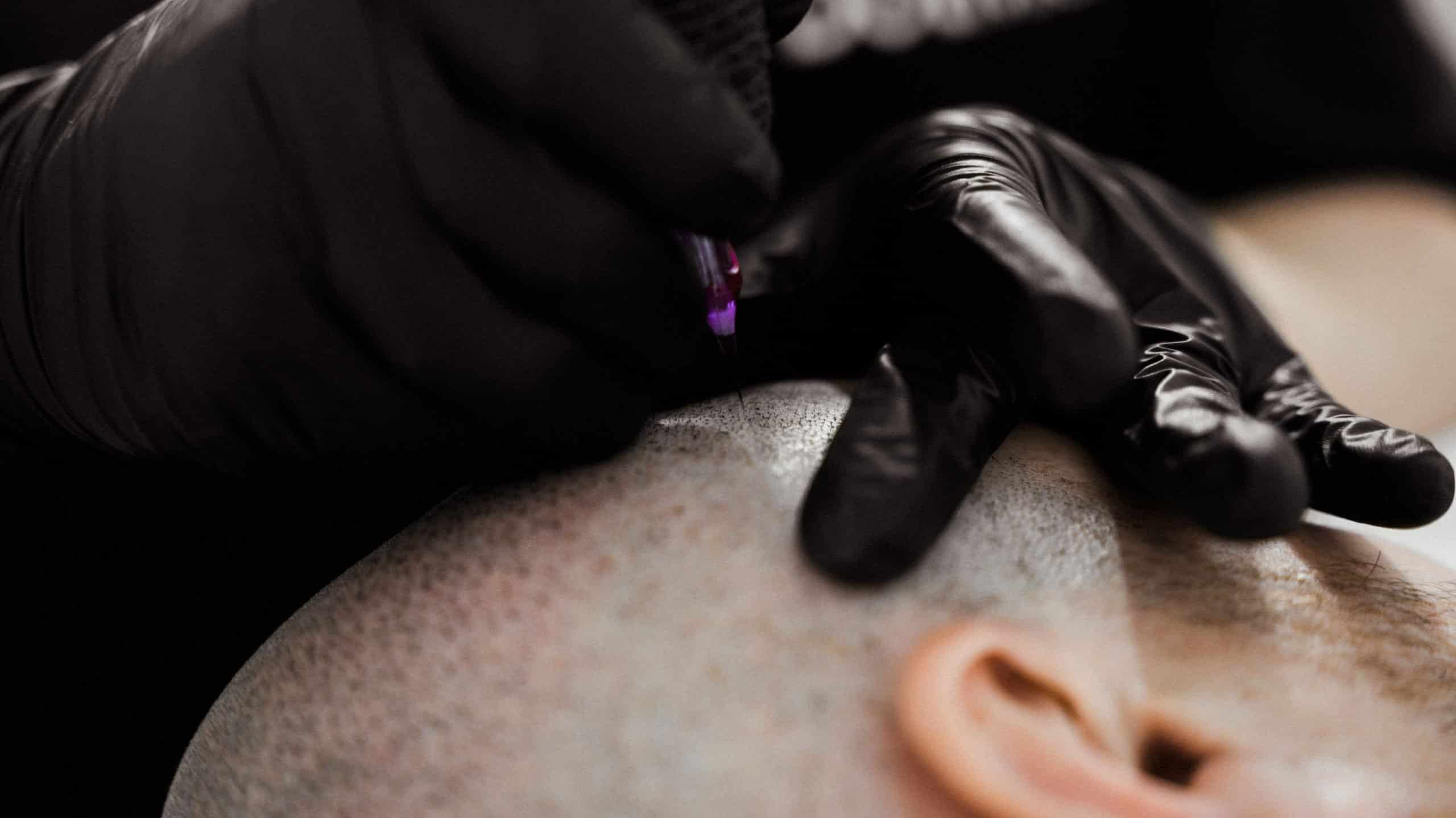 Close-up of scalp micropigmentation being applied during a treatment session