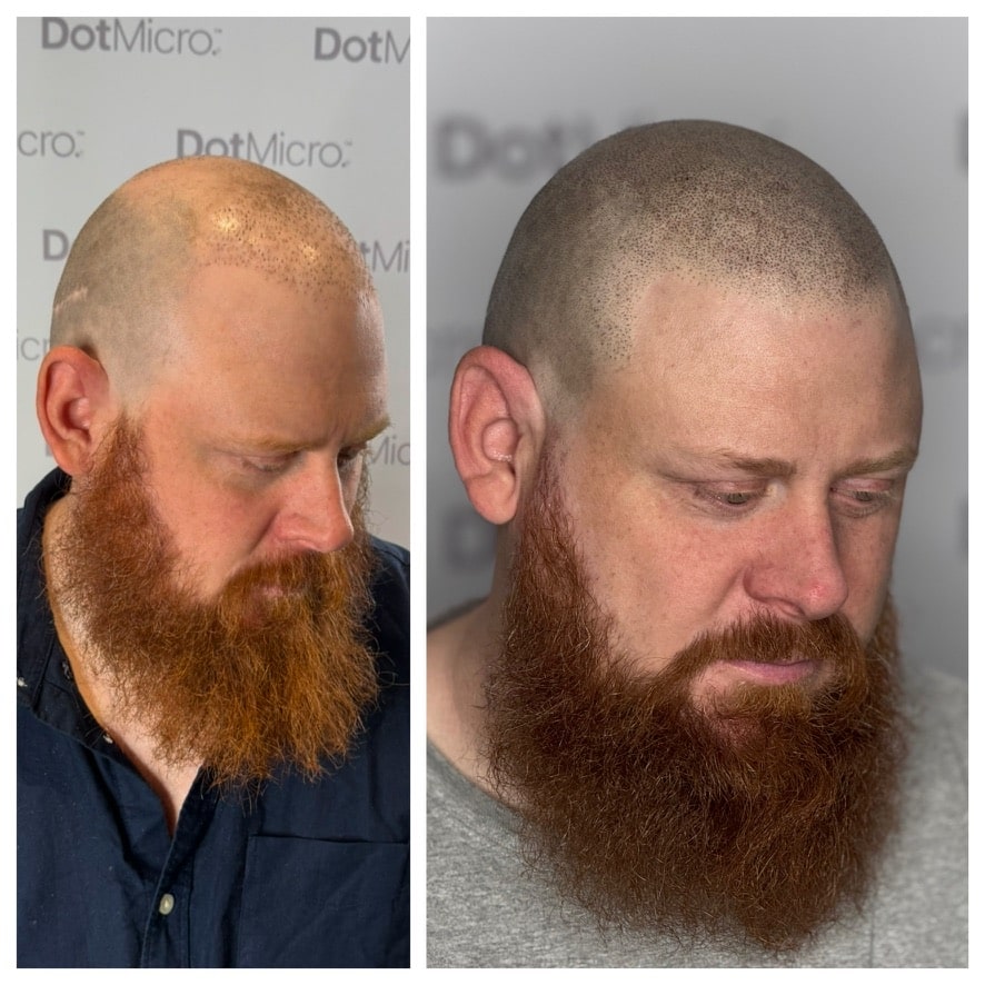 Before and after scalp micropigmentation showing visible change in scalp appearance
