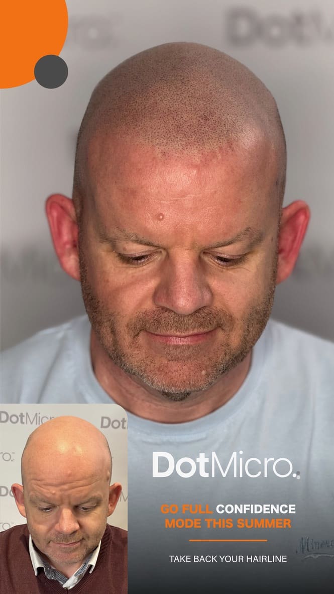 Shaved scalp micropigmentation showing defined hairline and even scalp coverage